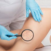 Tratamiento de escleroterapia para varices